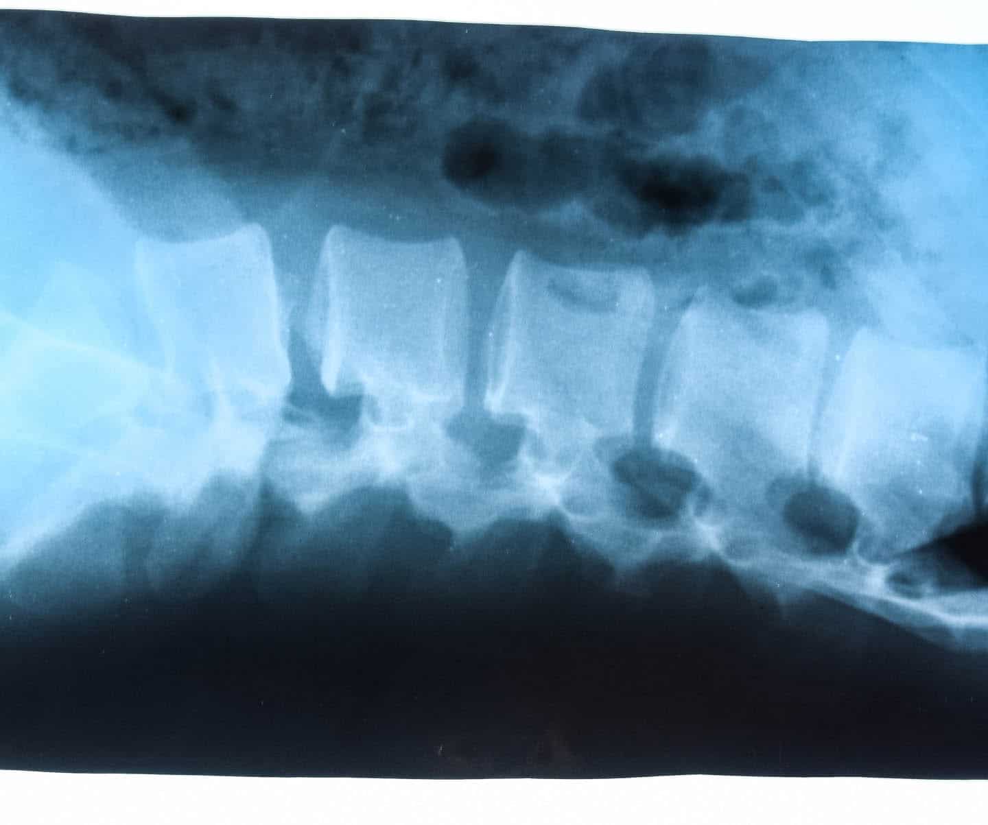 LWS Schmerzen - LWS-Syndrom