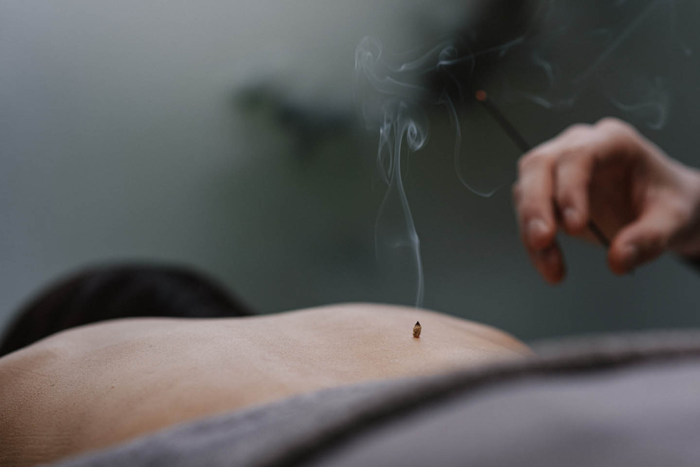 Moxibustion Moxibustion - Moxibustion