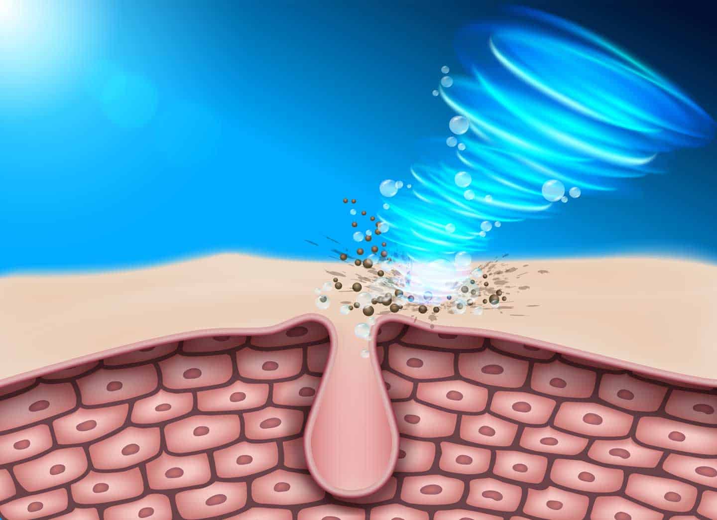 Akne Diagnose - Akne